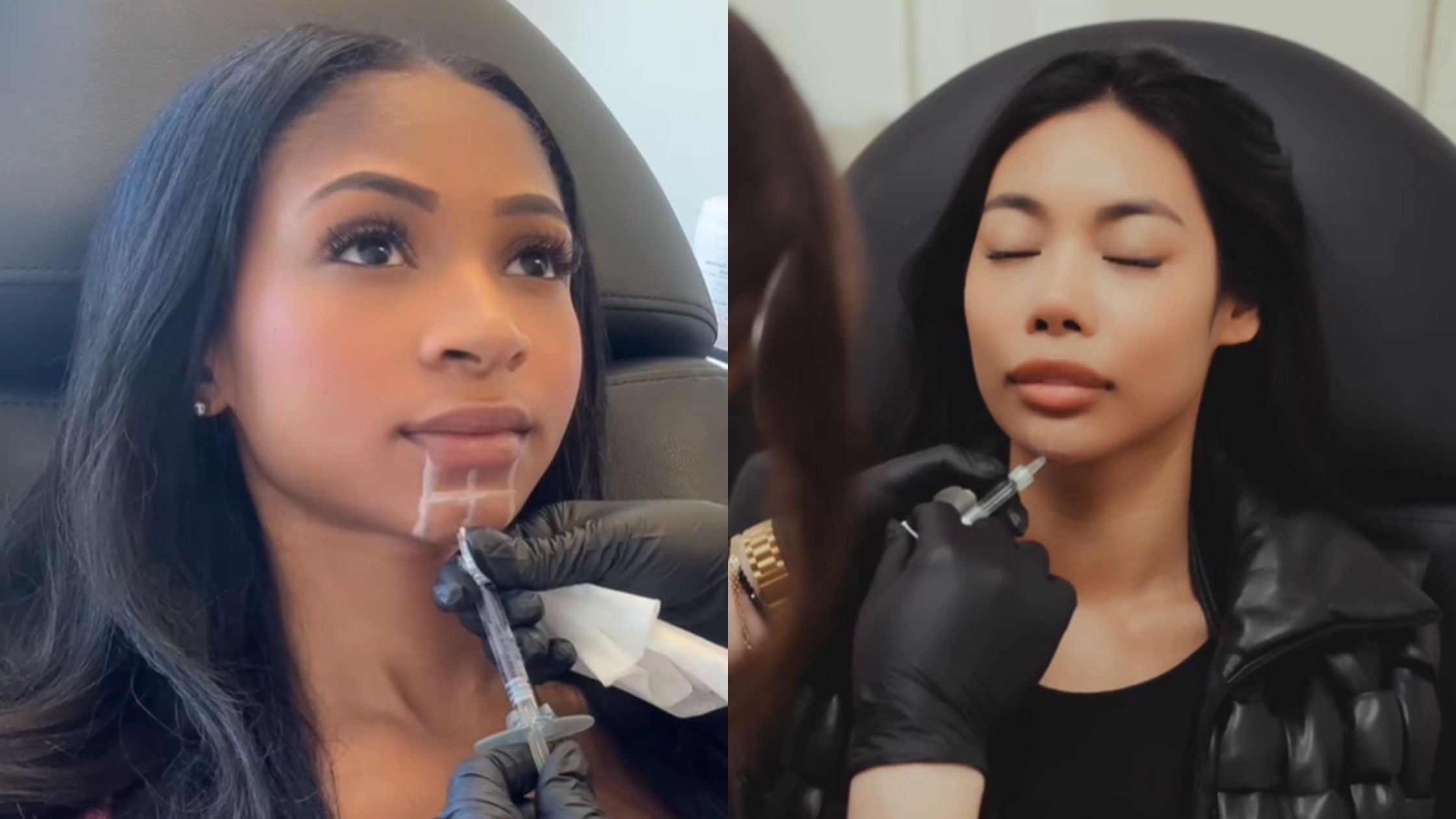 Affordable Chin Fillers in California and Arizona